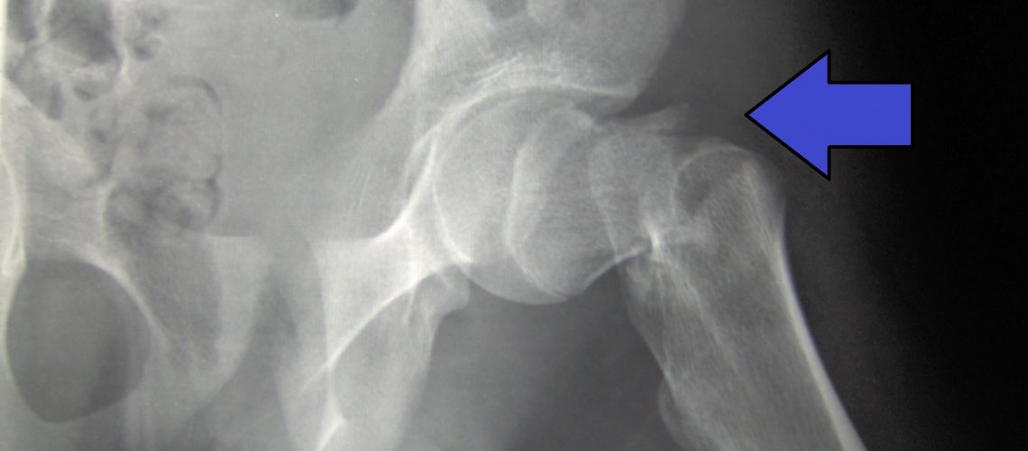 Cdm_hip_fracture_343