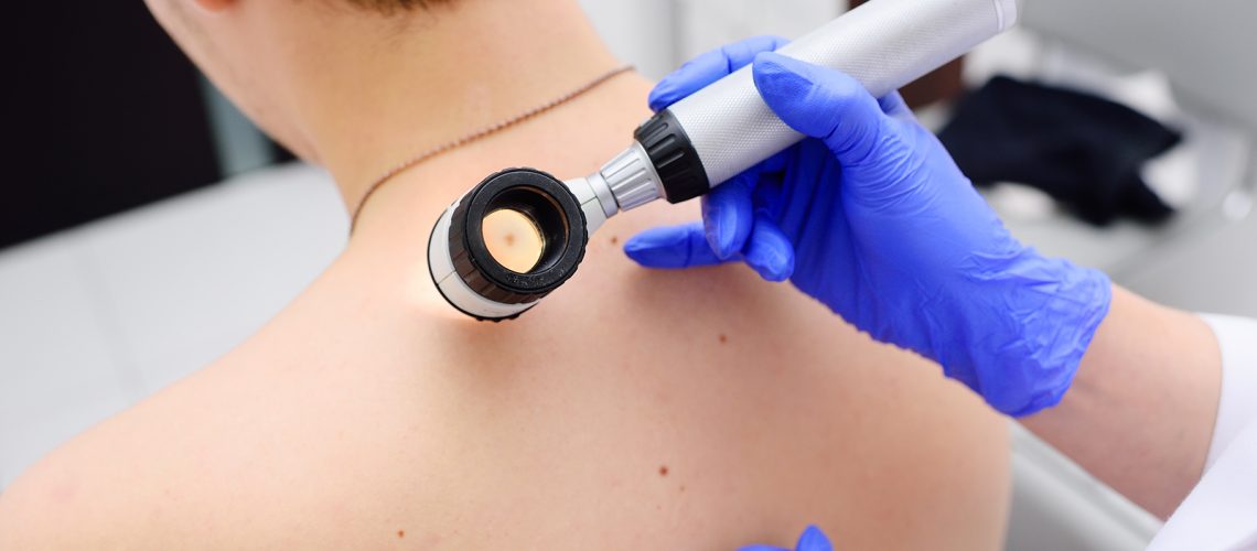 Fattori-di-rischio-e-prevenzione-del-melanoma