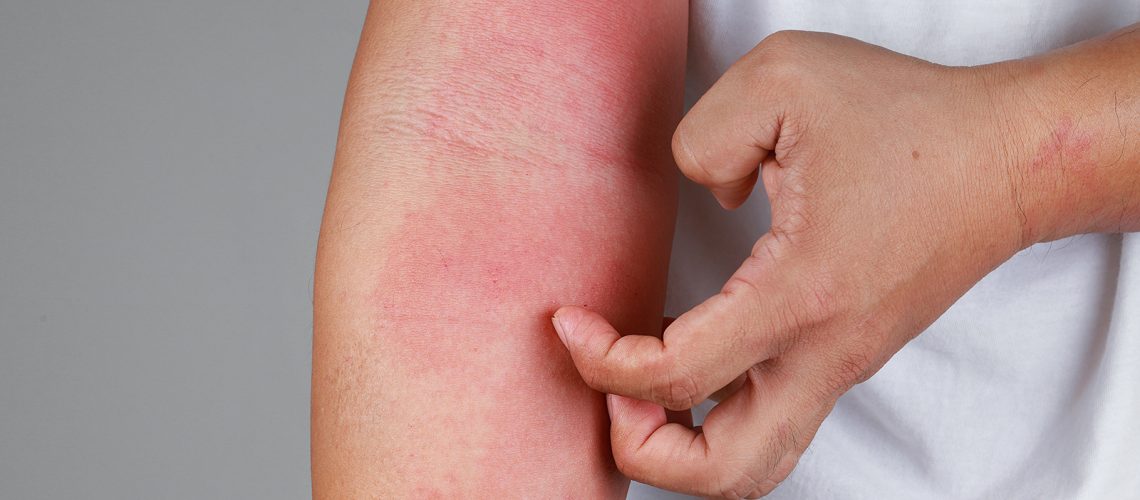 Il prurito che viene dal derma