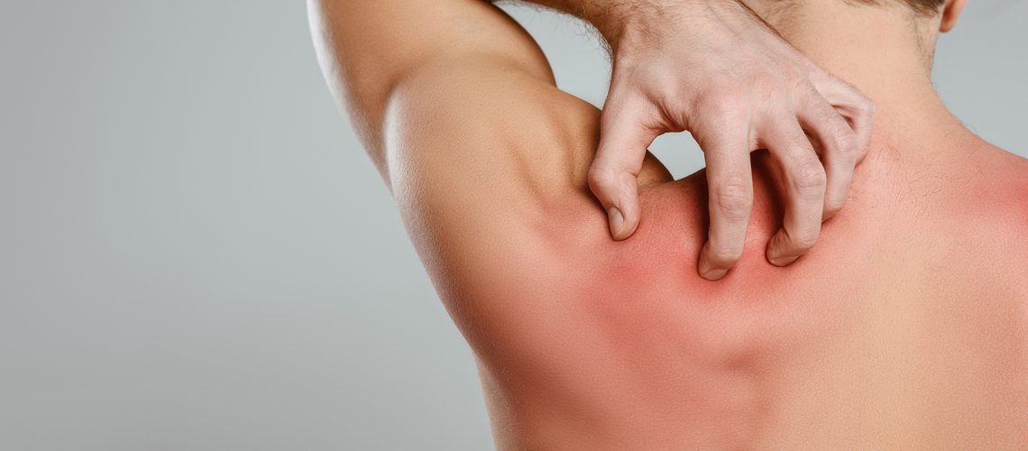 Reazione cutanea allergica e prurito