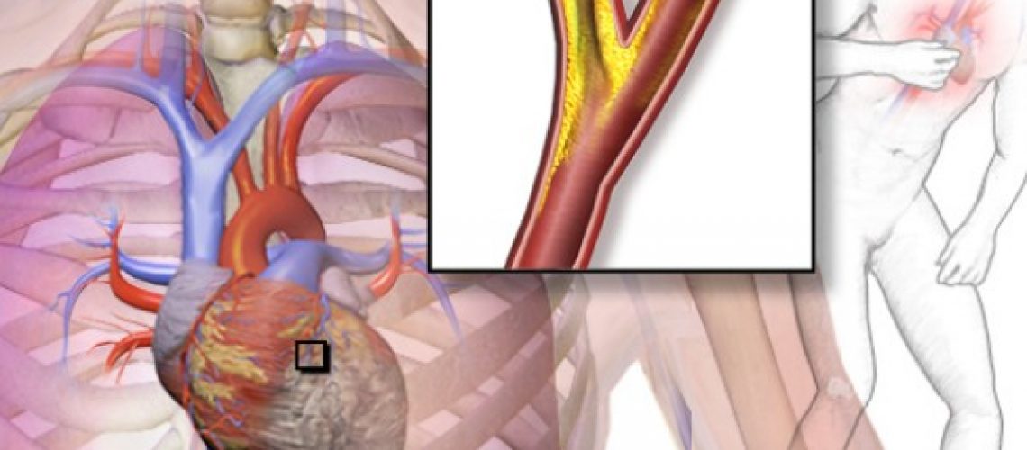 angina-pectoris-1