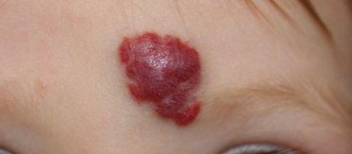 angioma-1