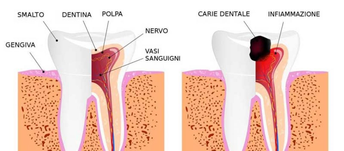 dente-sano-e-dente-cariato