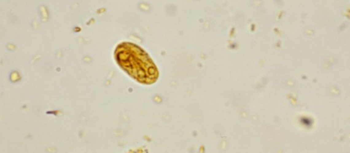 idrosadenite-suppurativa-1