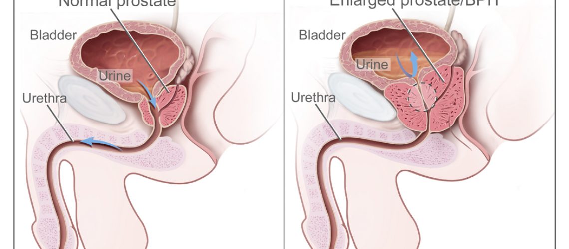 CDR462221 benign prostatic hyperplasia