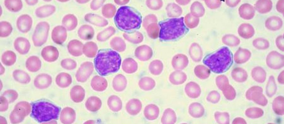 leucemia-mieloide-acuta