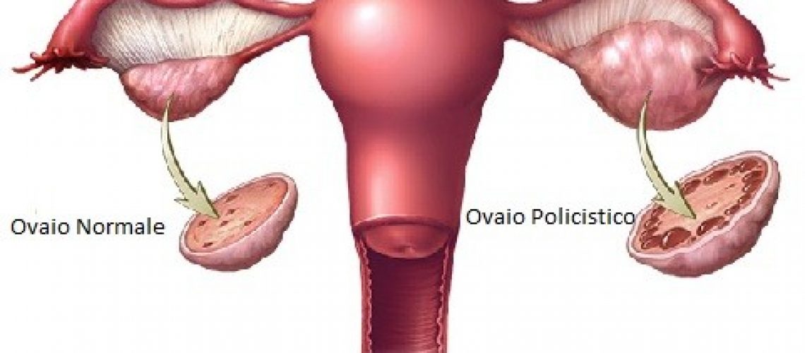 ovaio policistivo
