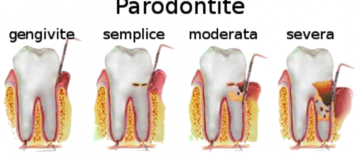 parodontite-gengivite-piorrea