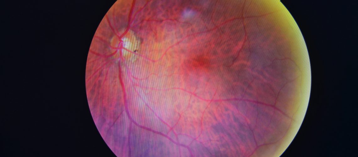 retinopatia