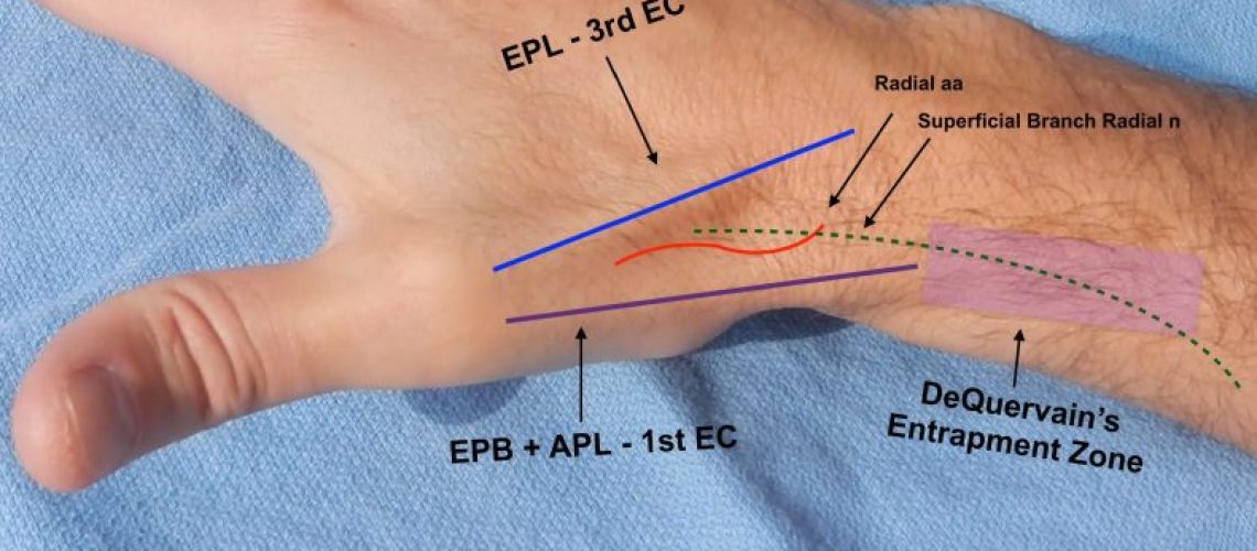sindrome-di-dequervain-790x460-1