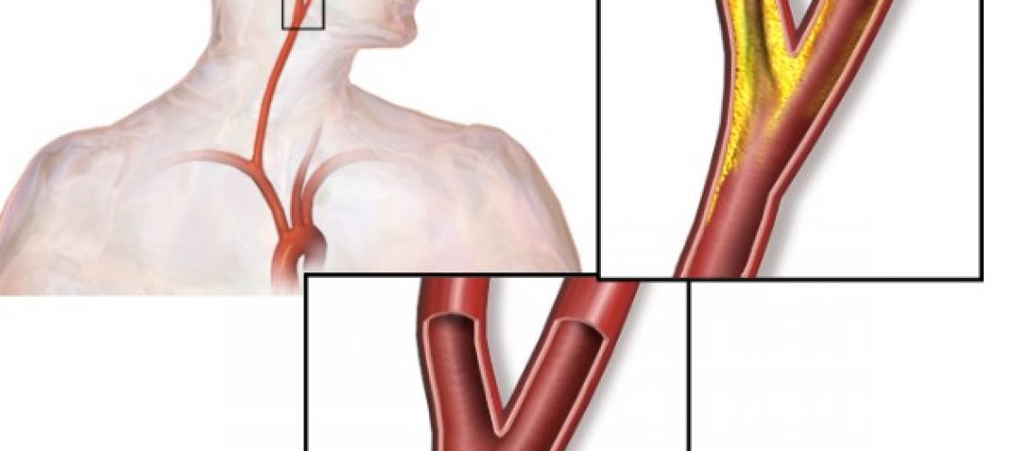 stenosi-carotidea-1