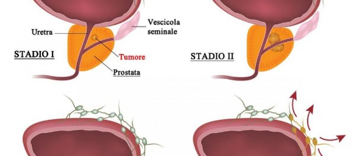 tumore-della-prostata-1